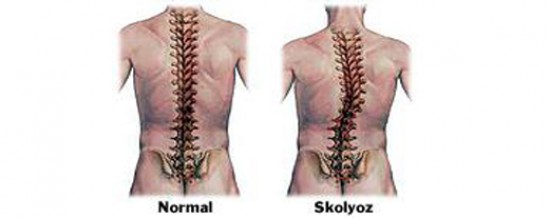 WHAT ARE THE TYPES OF SCOLIOSIS?