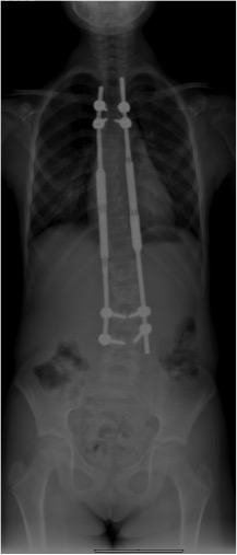 EARLY-ONSET SCOLIOSIS