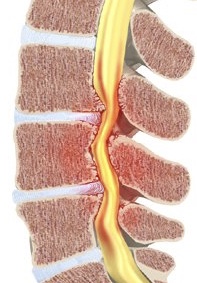 NARROWING OF SPINAL CANAL