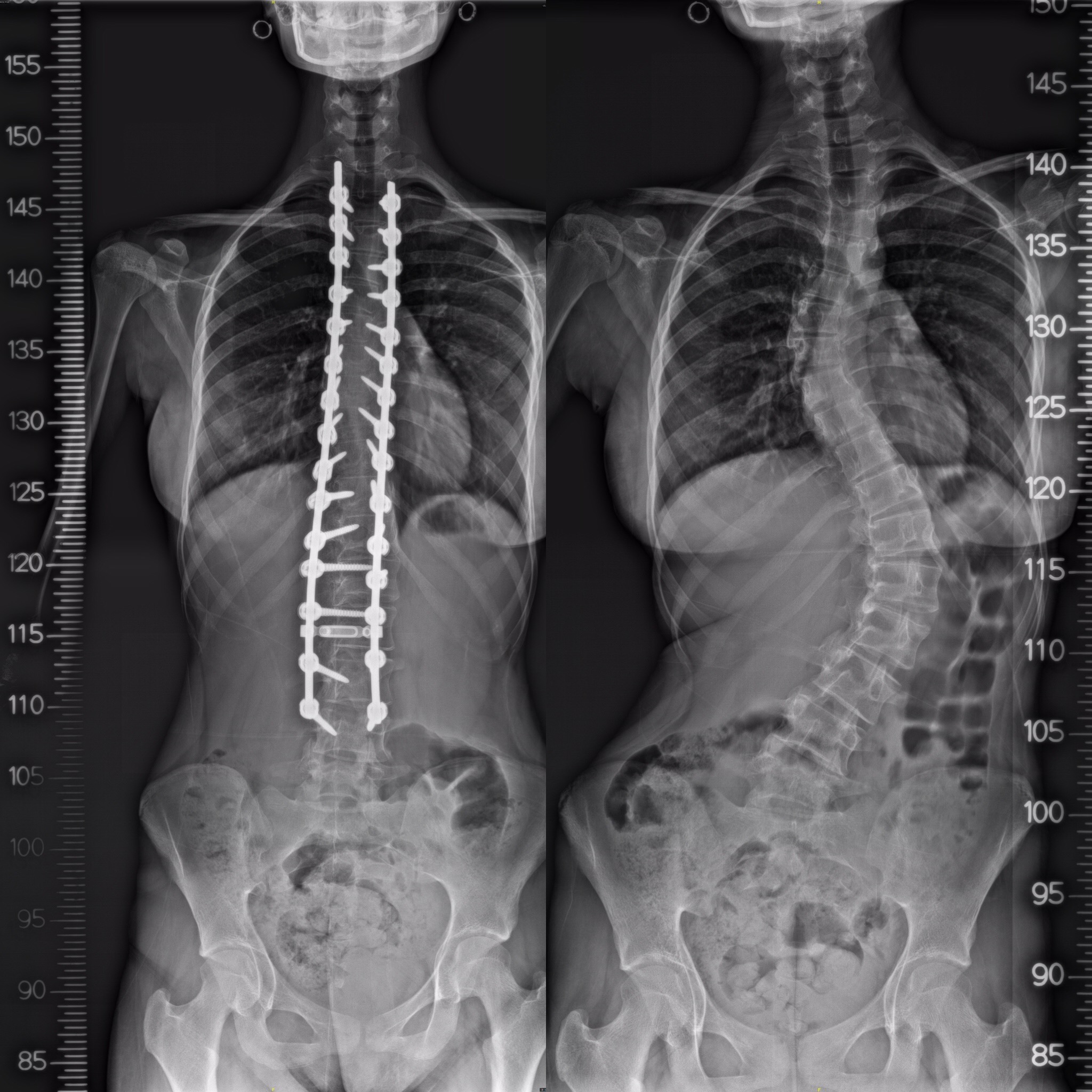 TREATMENT OPTIONS FOR SCOLIOSIS