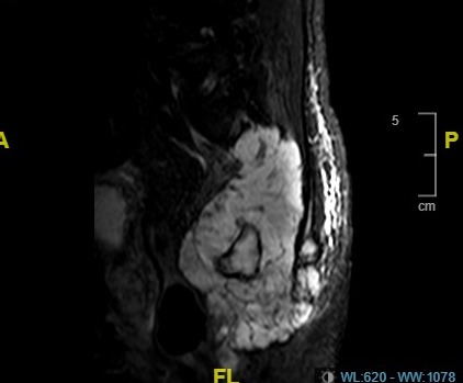 SPINAL  TUMORS