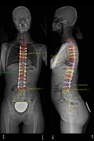 ADULT SCOLIOSIS