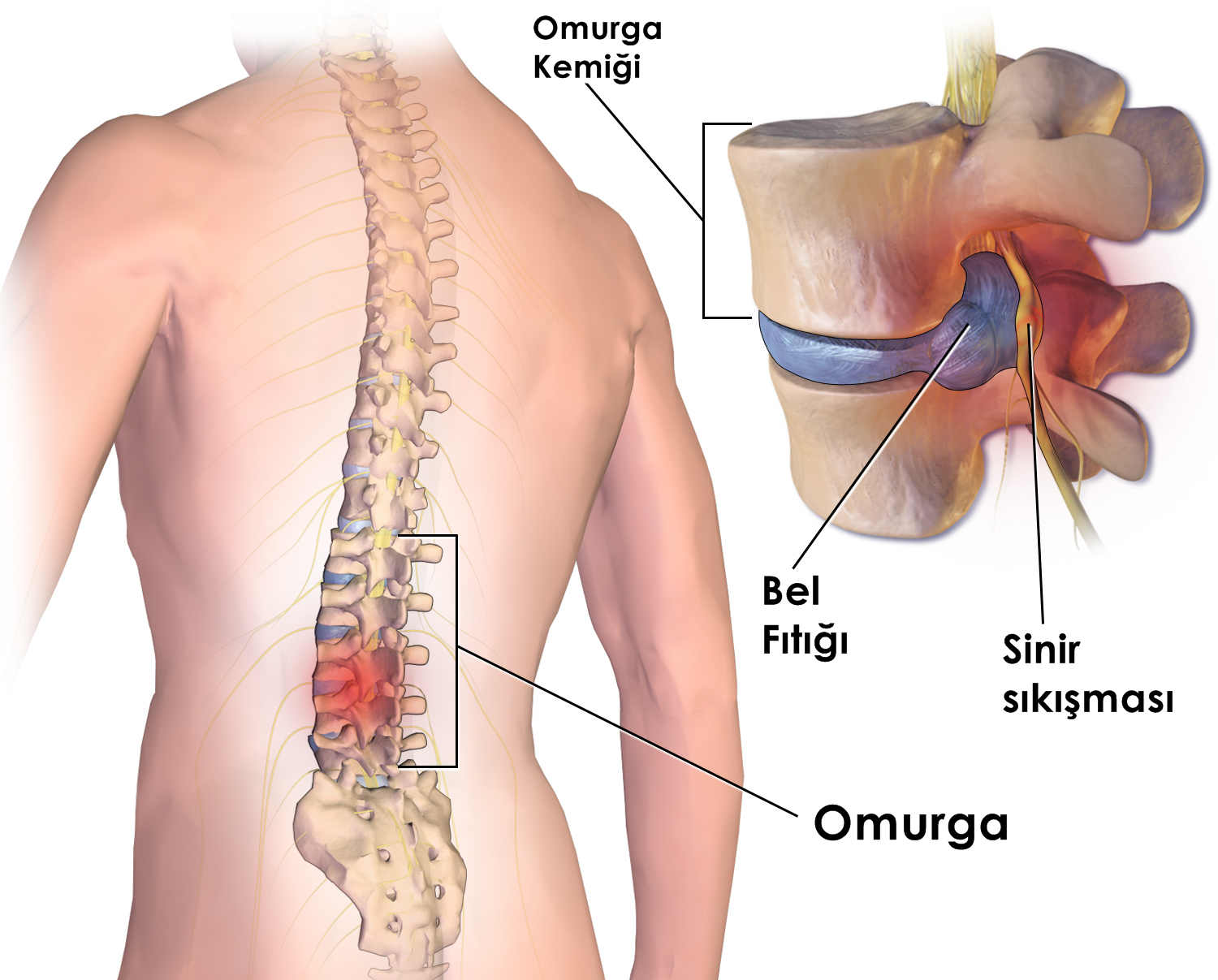 HERNIATED DISC IN LOWER BACK